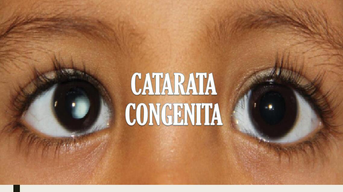 CATARATA CONGENITA PPT Doctorada11 UDocz