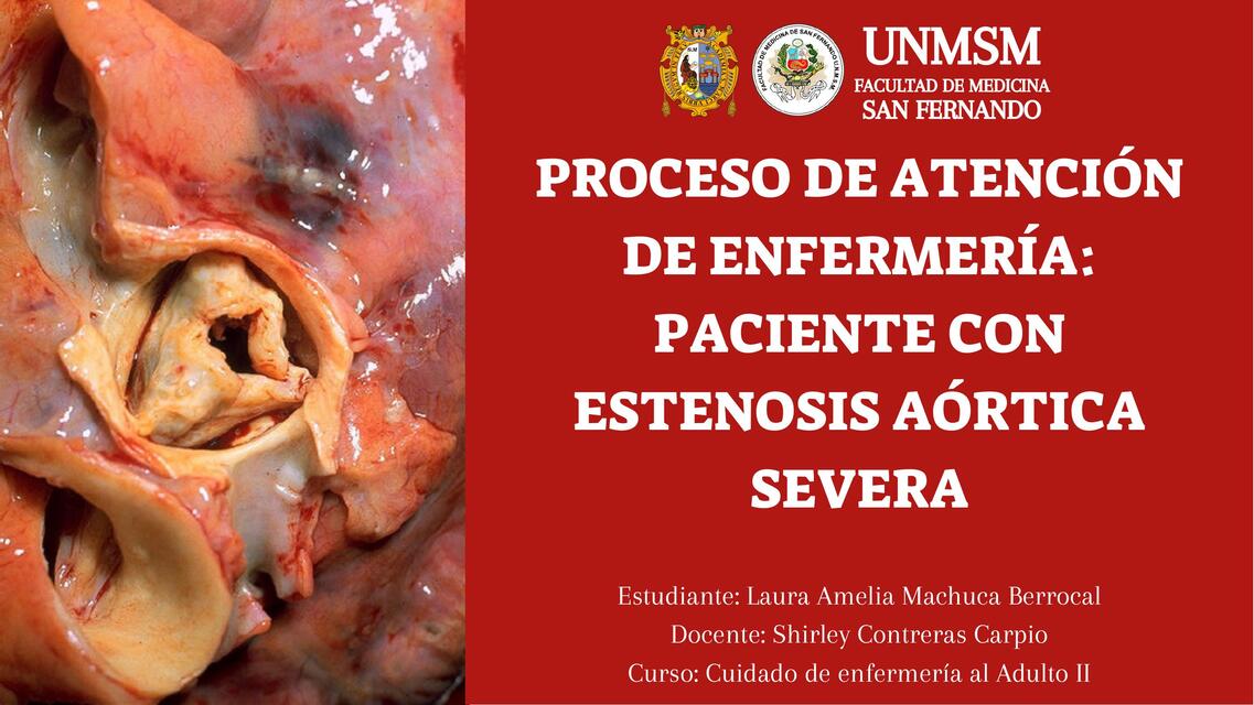 PRESENTACIÓN PAE PACIENTE CON ESTENOSIS AORTICA Lau uDocz