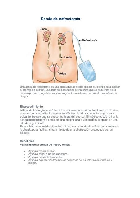 Sonda De Nefrectomía Aura Ester Peréz Rada uDocz