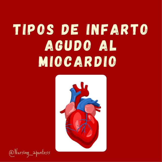 Tipo De Infarto Agudo De Miocardio Nursing Apuntes UDocz