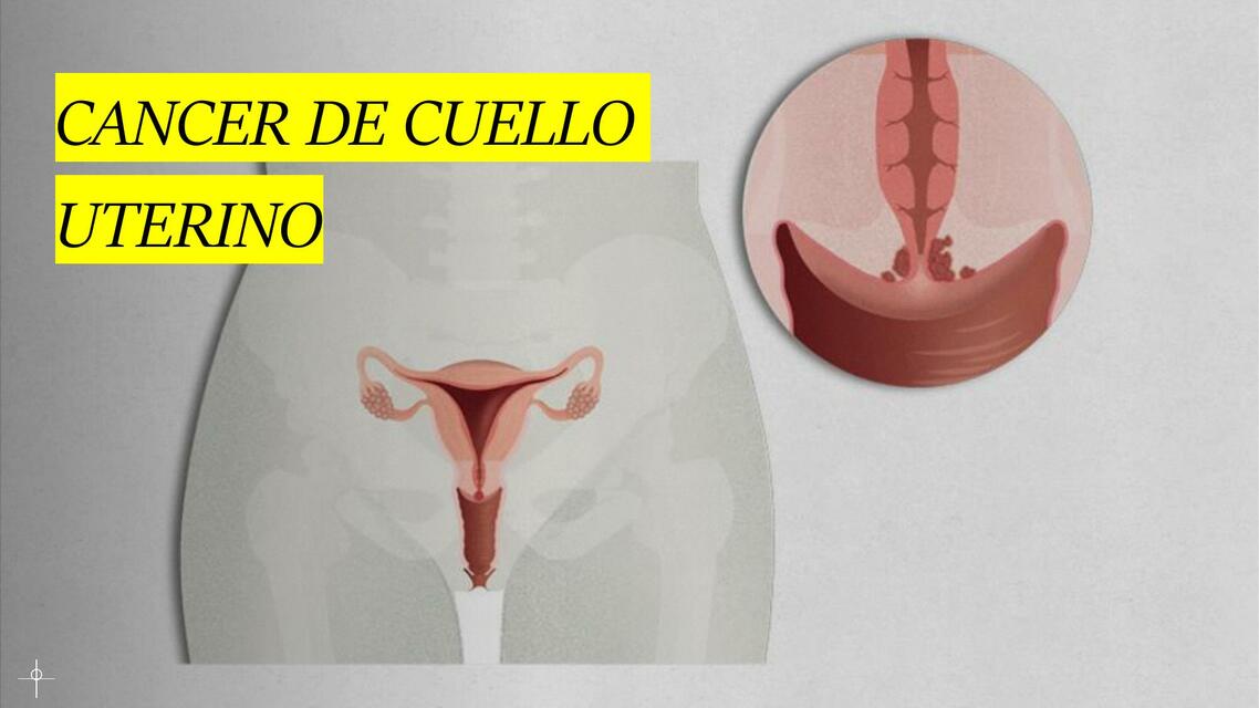 Cancer De Cuello Uterino Crismar Ovalles UDocz