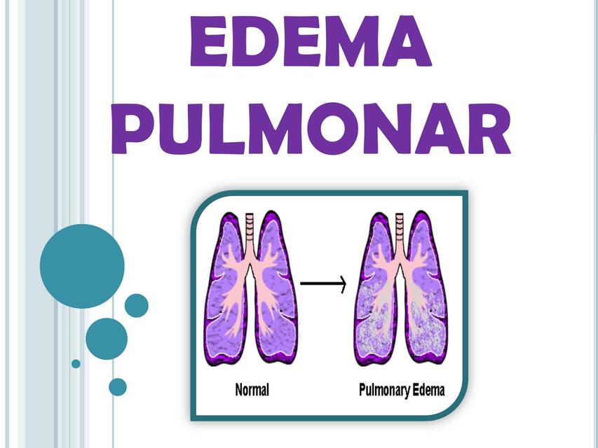 Edema Pulmonar Yelmy Perez Udocz