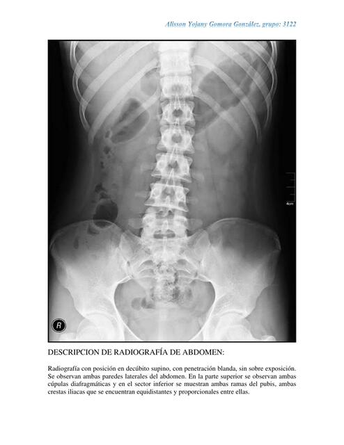 Descripcción de radiografía abdomen Alisson Gomora Gonzalez uDocz