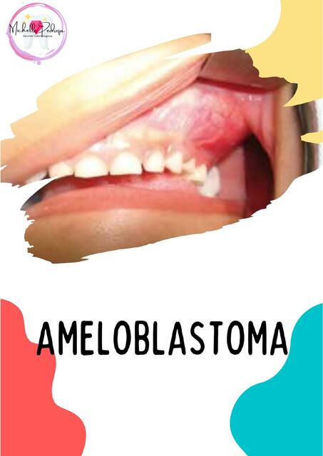 Ameloblastoma Michelle Pedroza Udocz