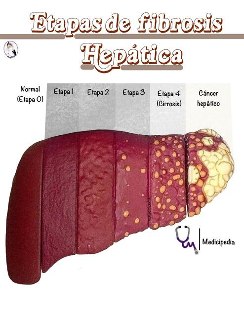 Etapas Fibrosis Hepatica Udocz Hot Sex Picture