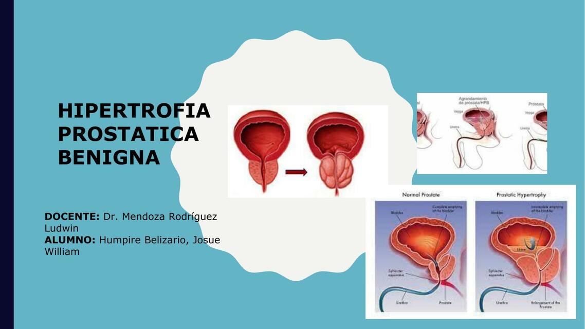 Hipertrofia Prostática Benigna Josue HB uDocz