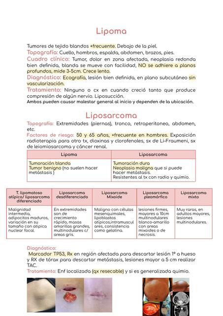 Lipoma Liposarcoma Mar Med Udocz