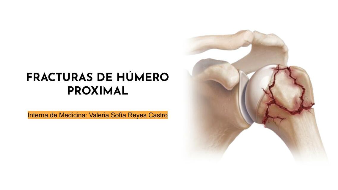 Fracturas de húmero proximal uDocz