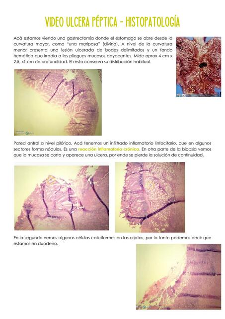 Video Ulcera P Ptica Medicina En La Uner Udocz