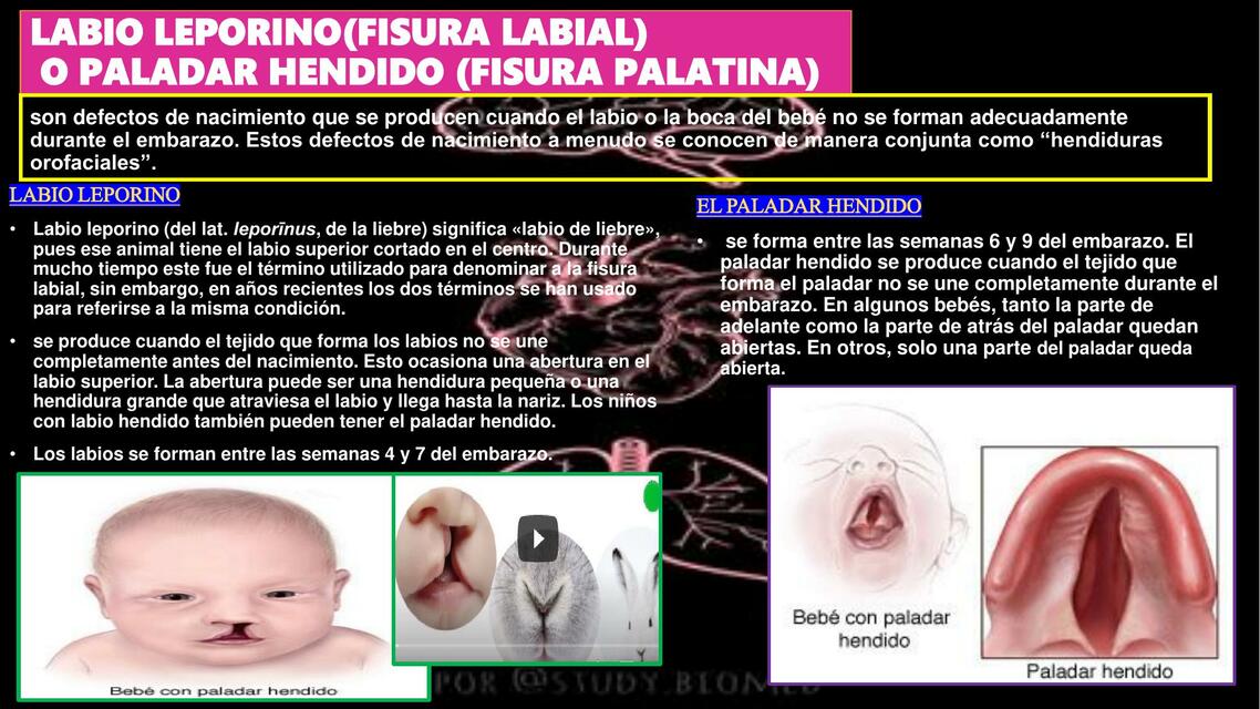 Labio Leporino Fisura Labial O Paladar Hendido Fisura Palatina