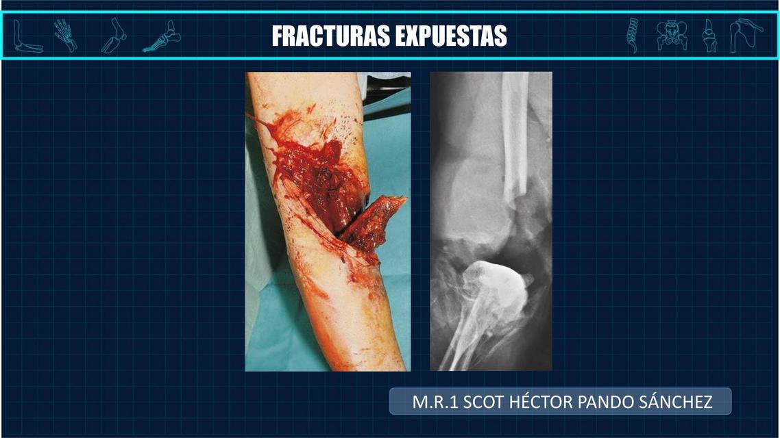 FRACTURAS EXPUESTAS Ledy Ama UDocz