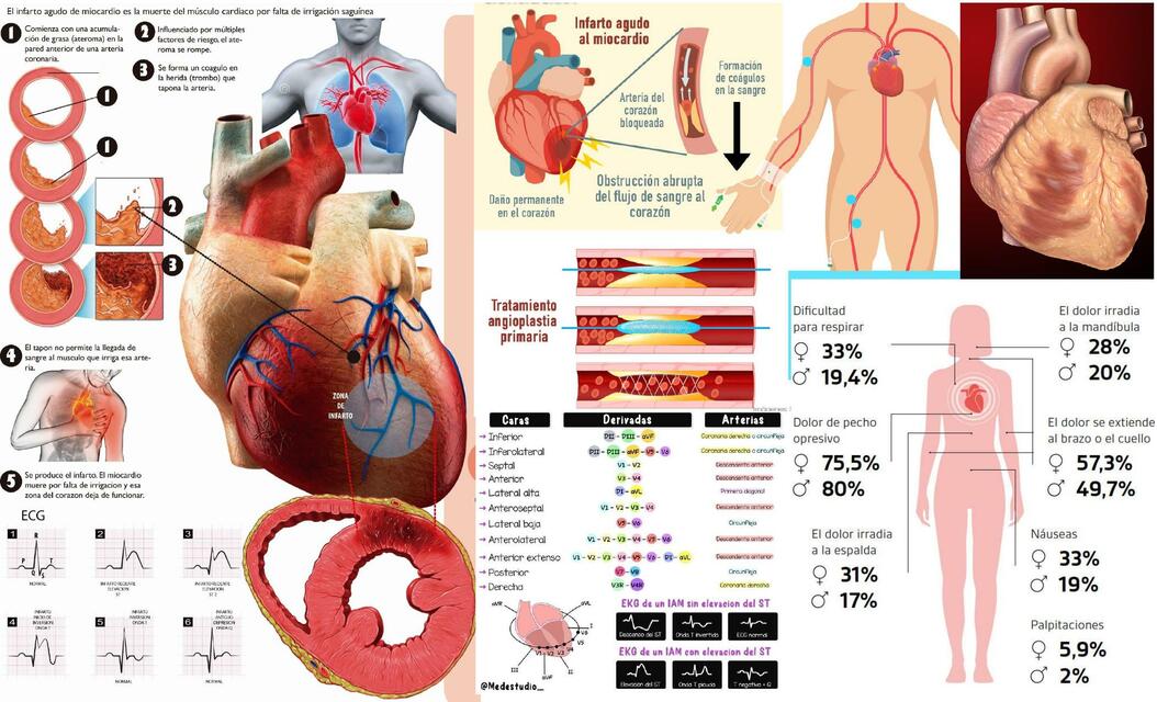 Infograf A Infarto Agudo Al Miocardio Luis Fabrizio Chapital Velasco