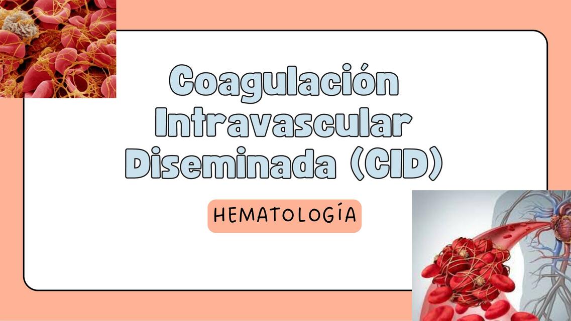 Coagulaci N Intravascular Diseminada Cid Nancy A C Udocz