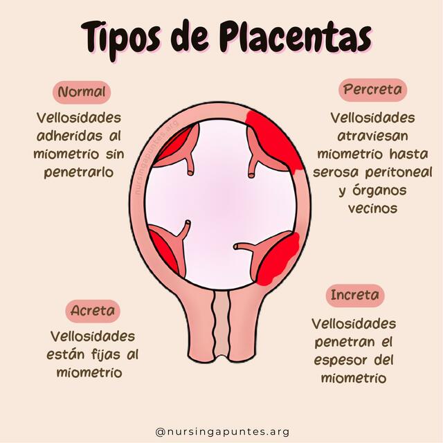 Placentas Enfermer A Udocz