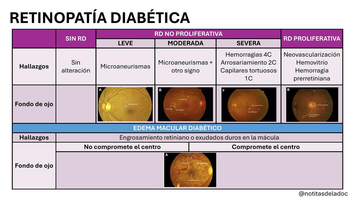 Clasificación de la retinopatía diabética La Doc uDocz