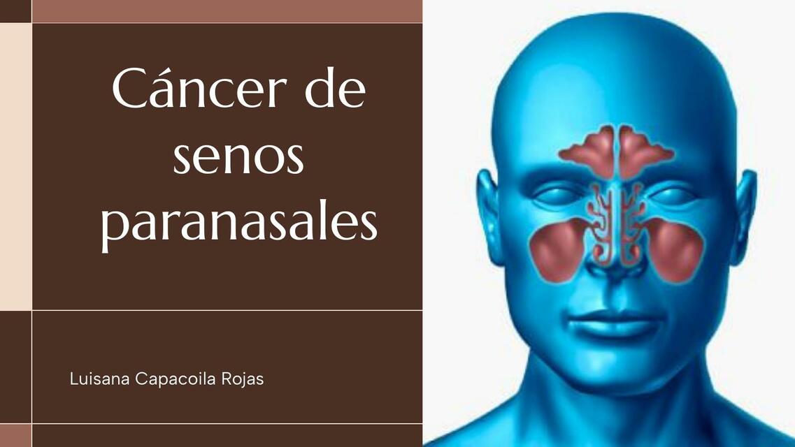 CÁNCER DE SENOS PARANASALES Luisana Aneth CR uDocz