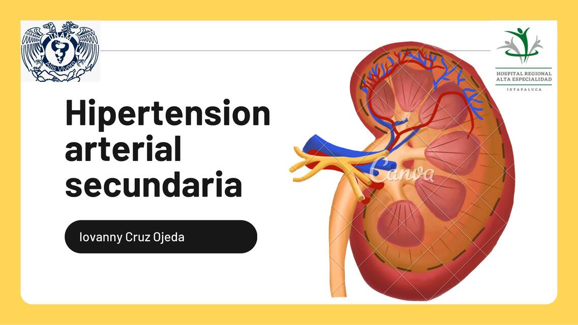 Hipertension Arterial Secundaria IOVANNY CRUZ OJEDA UDocz