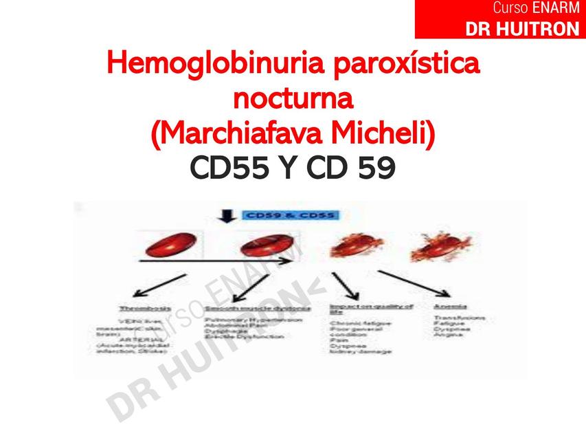 Hemoglobinuria paroxistica