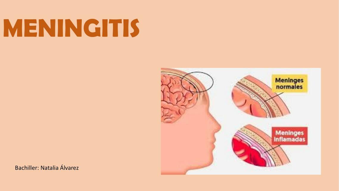 MENINGITIS