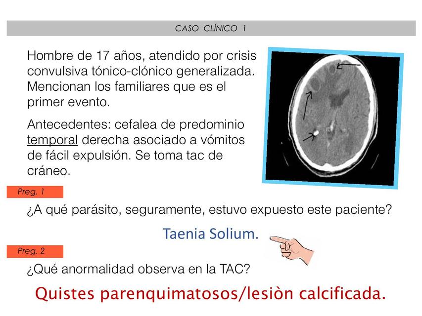 CISTICERCOSIS