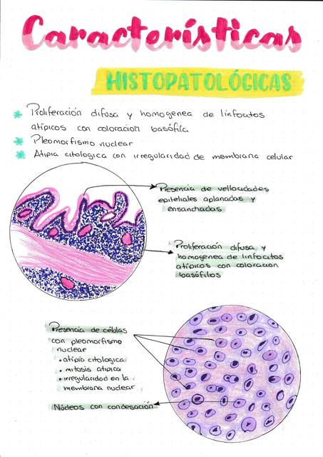 LINFOMA INTESTINAL 