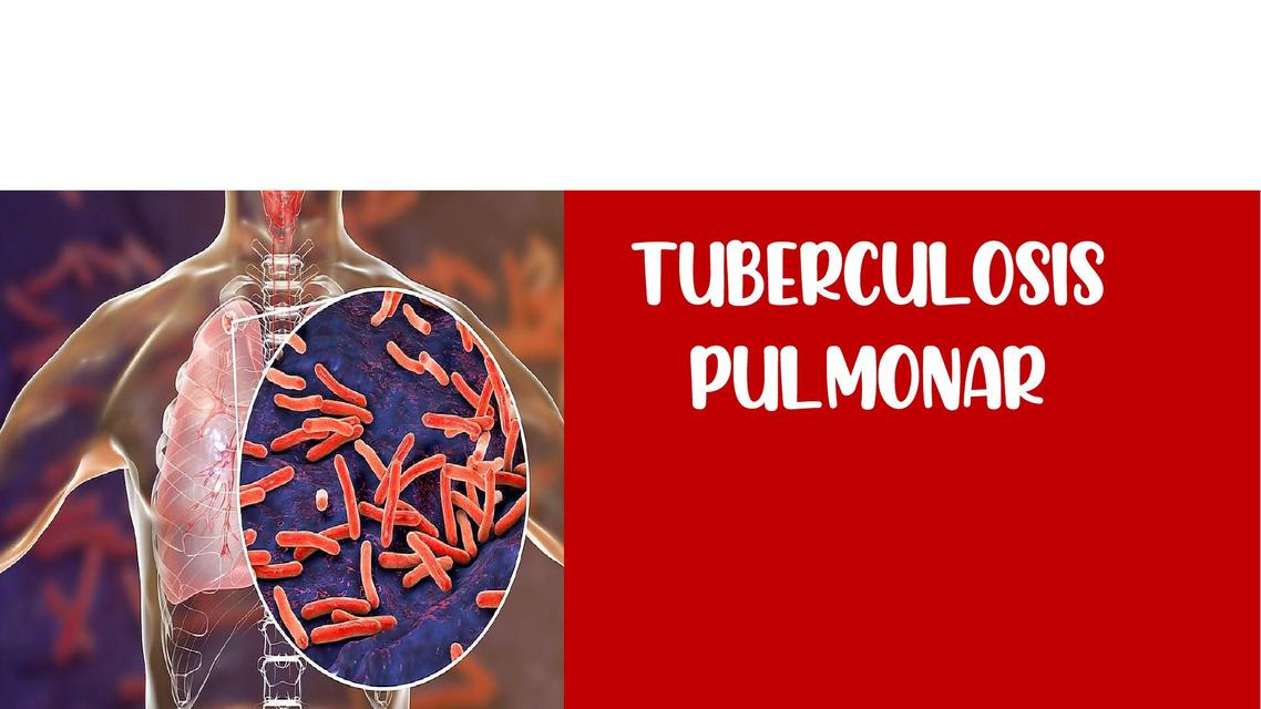 Tuberculosis 