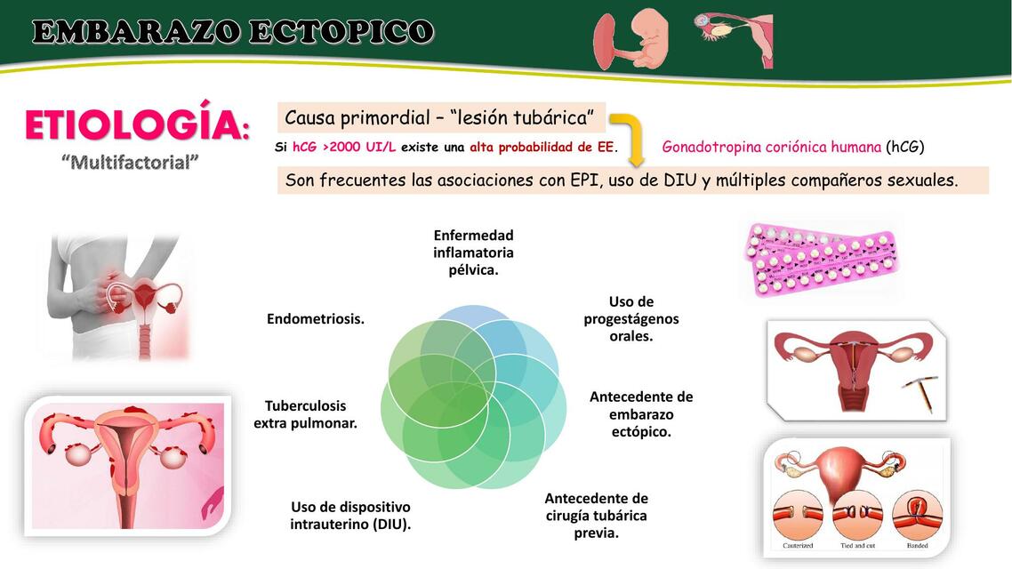 EMBARAZO ECTOPICO ETIOLOGIA FR CLASIFICACIÓN