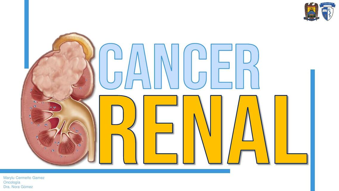 Cáncer renal copia