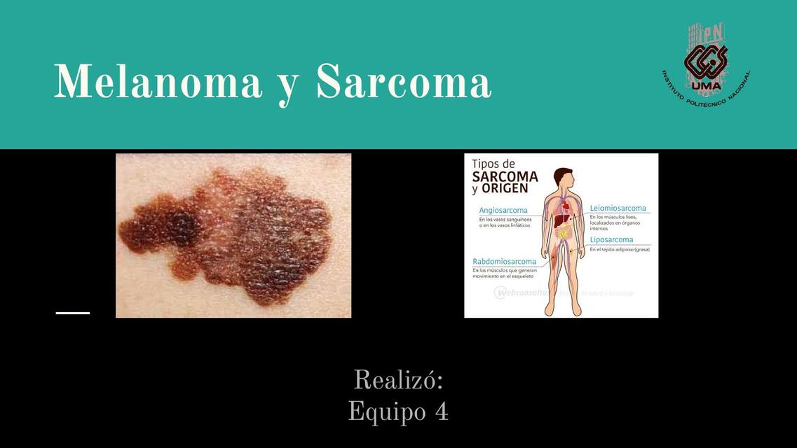 Melanoma y sarcoma Equipo 4