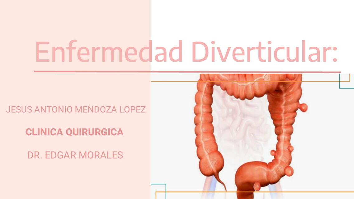 Enfermedad Diverticular