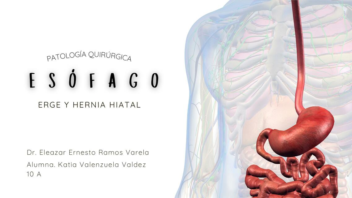 Esófago ERGE y HERNIA HIATAL