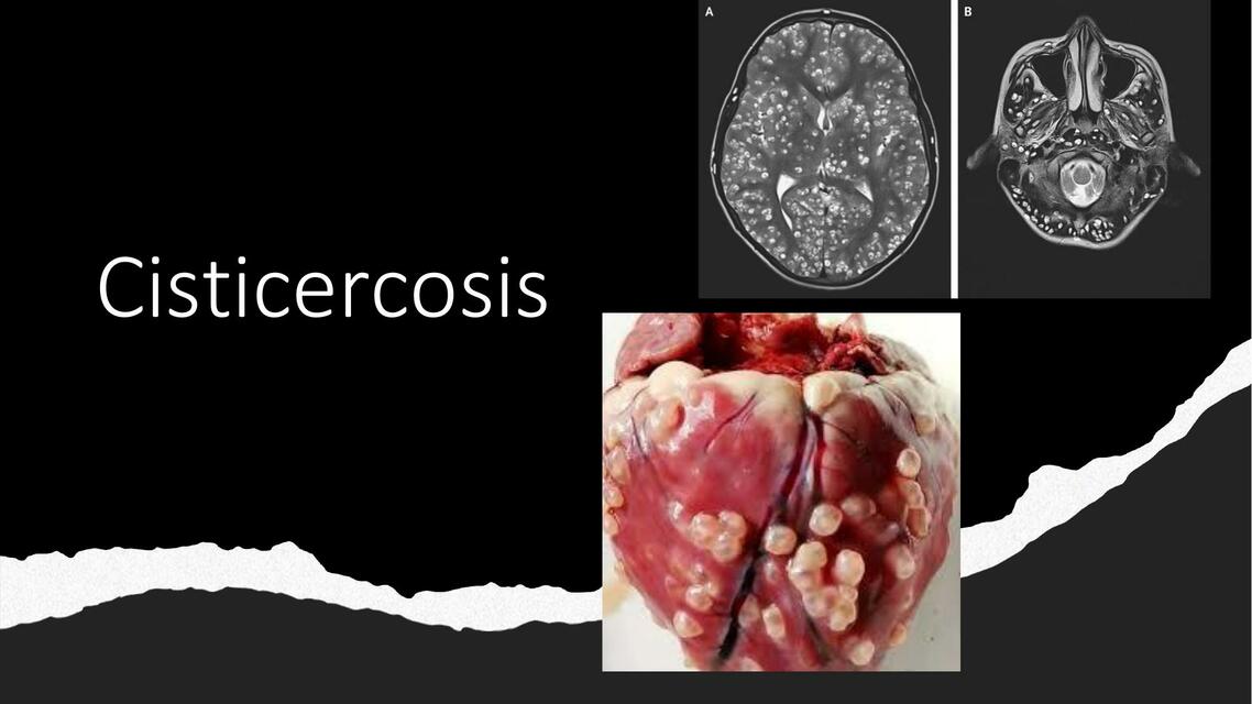 TEMA 9 CISTICERCOSIS