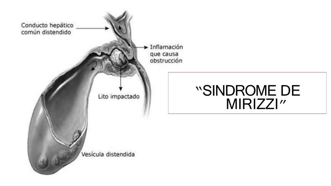 sindrome de mirizzi