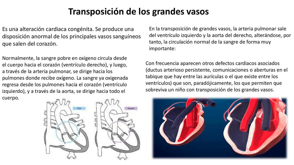 transposición de los grandes vasos