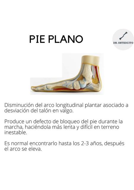 Pie plano y pie cavo