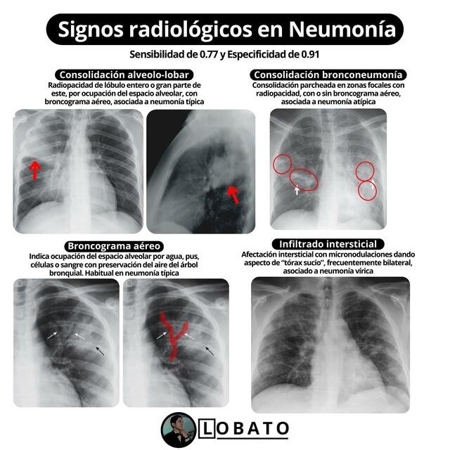 Neumonía en radiografía de tórax 🩺