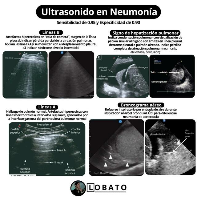 Ultrasonido en Neumonía 🩺