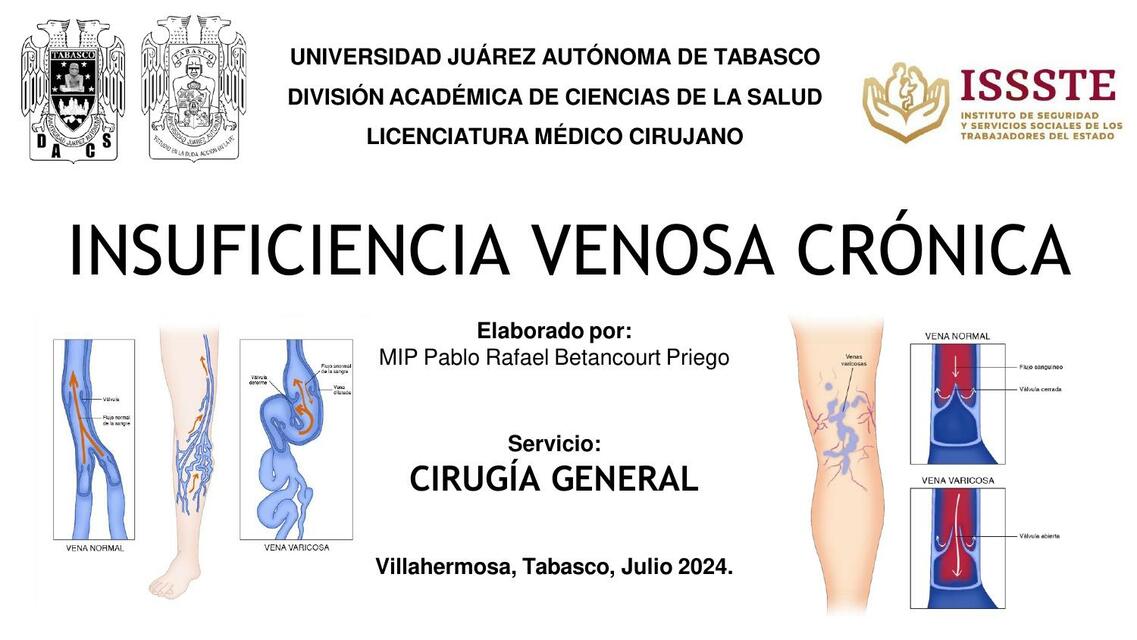 Insuficiencia venosa crónica