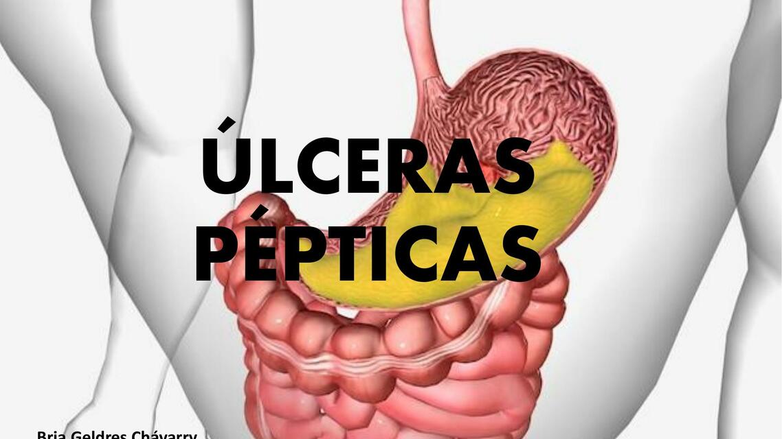 ÚLCERAS PÉPTICAS