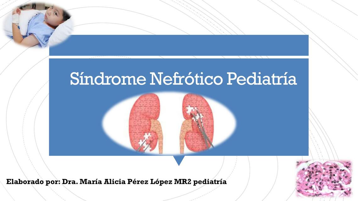 sindrome nefrotico alicia