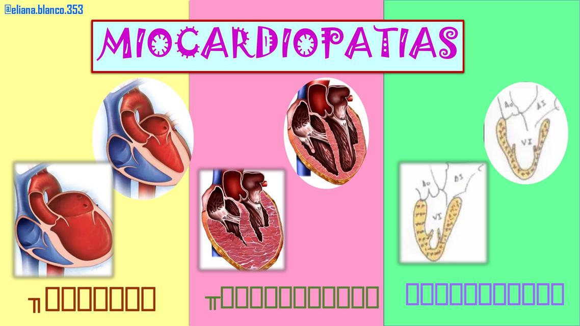 Miocardiopatías