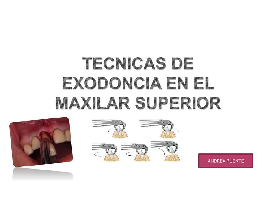 Tecnicas de extraccion maxilar superior CIRUGIA BUCAL