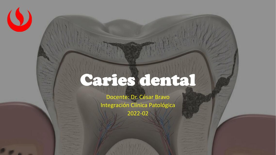 Caries 2