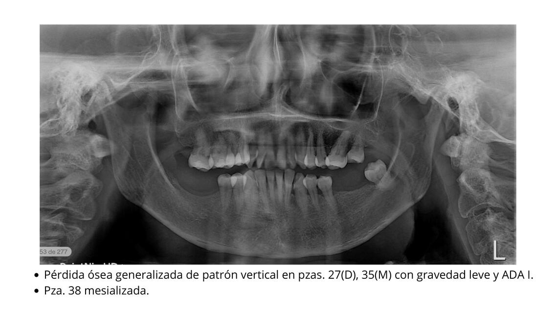 Pérdida ósea generalizada de patrón vertical en