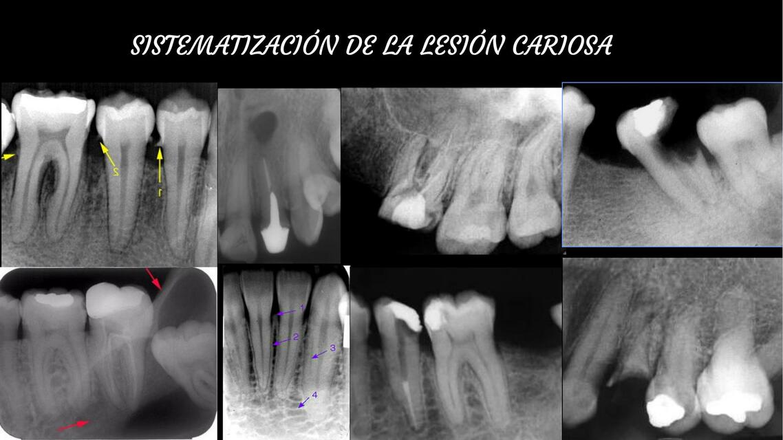 13 Interpretación de la Lesión cariosa pptx