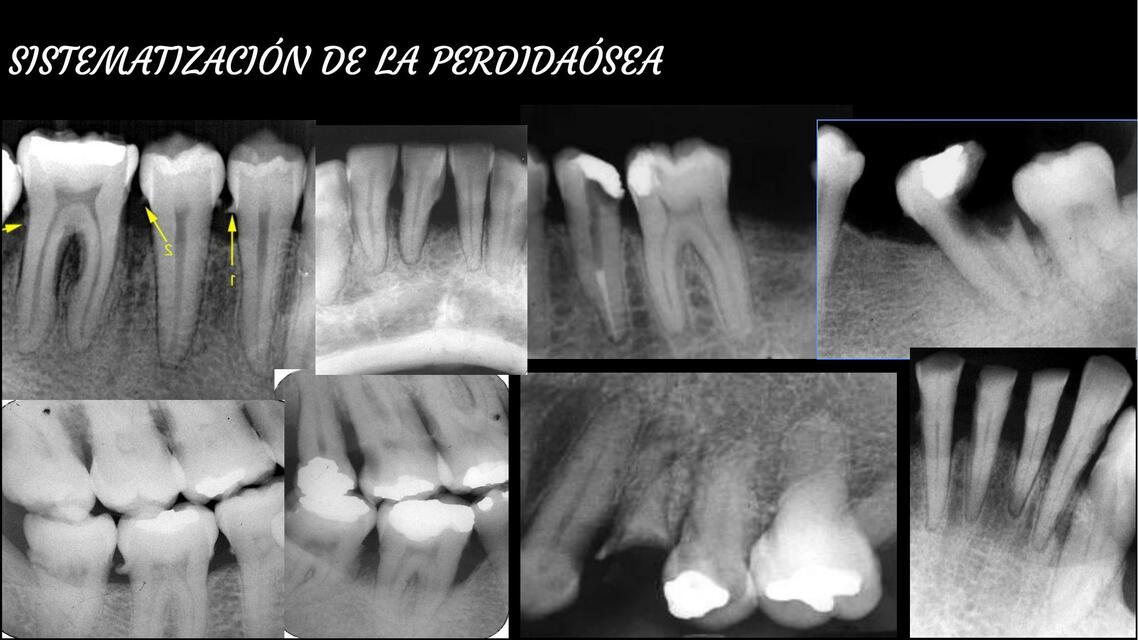 12 Interpretación de la Perdida Ósea 1 pptx 2