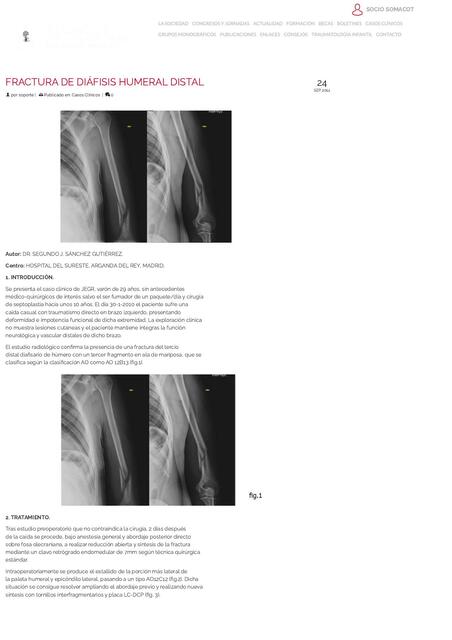 FRACTURA DE DIÁFISIS HUMERAL DISTAL SOMACOT Socied