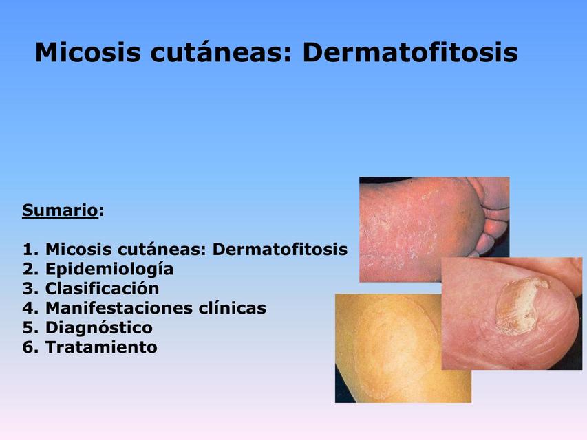 Micosis cutáneas dermatofitosis