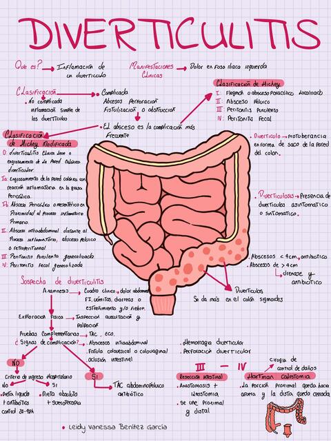 Diverticulitis