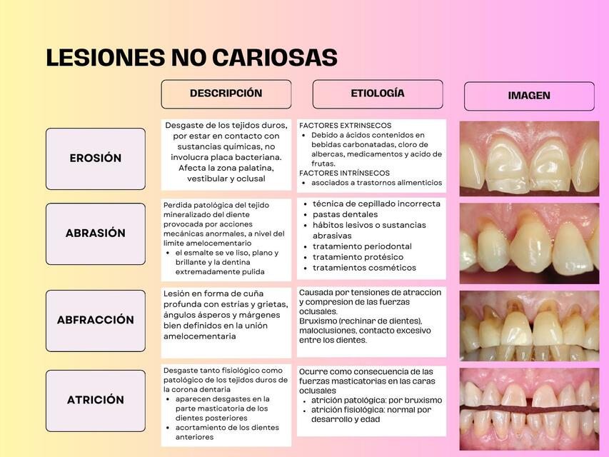 Lesiones no cariosas y su etiología